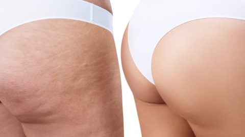 ¿Cómo se puede perder permanentemente la celulitis en los glúteos?