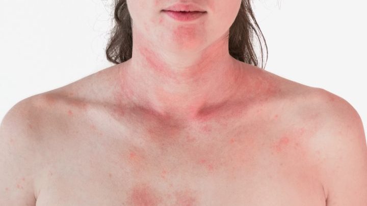 ¿Cómo se eliminan los eczemas de la cara y el cuello?