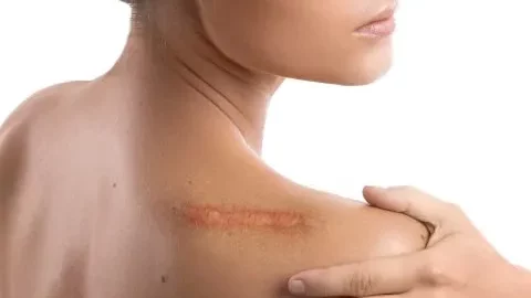 ¿Cómo evitar las cicatrices hipertróficas?