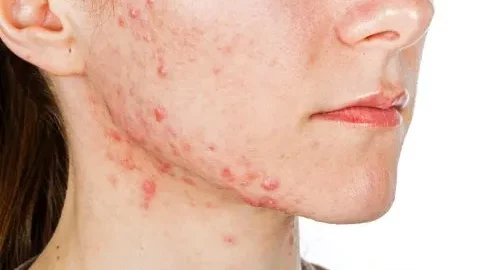 ¿Cuál es el mejor tratamiento para el acné hormonal?
